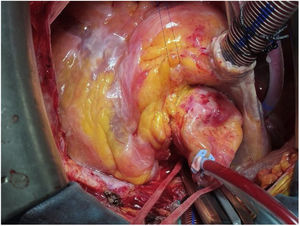 Aorta colapsada tras finalizar la administración de cardioplejia. Se aprecia el límite del marco de nitinol.
