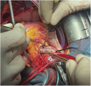 Disección con espátula de endarterectomía.