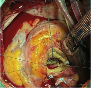 Estado de la aorta y anillo aórtico tras liberar la CoreValve®.