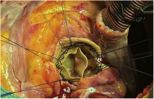 Resultado final. Perceval® Plus L.