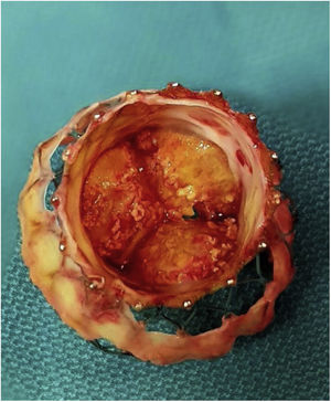CoreValve® degenerada tras 8 años. El análisis de la válvula muestra una degeneración precoz, con apertura limitada de los velos y daño estructural, en posible relación con valvulopastia percutánea previa.