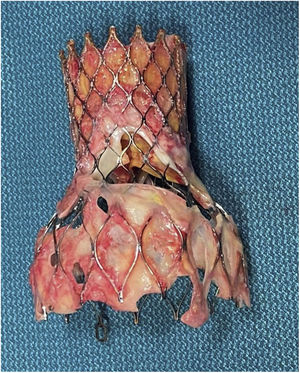 CoreValve® degenerada tras 8 años. El análisis de la válvula muestra una degeneración precoz, con apertura limitada de los velos y daño estructural, en posible relación con valvulopastia percutánea previa.