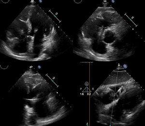 Cortes del ecocardiograma transesofágico mostrando vegetación adherida a electrodo ventricular del marcapasos.