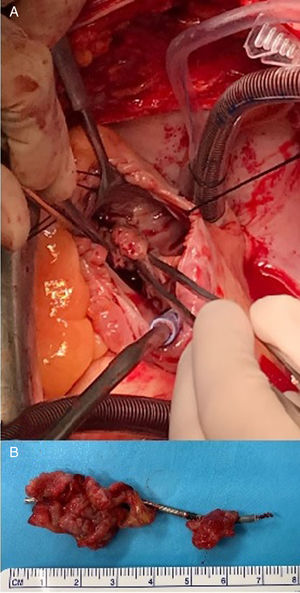 Imágenes tomadas en el quirófano A. Pinza quirúrgica sosteniendo vegetación. B. Vegetación anclada a electrodo ventricular.