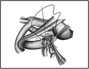Illustration of MBTT-Shunt Procedure.