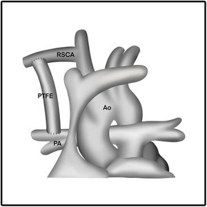 Illustration of MBTT-Shunt Procedure.