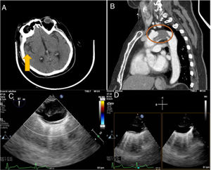 A) Tomografía axial craneal: proceso isquémico hiperagudo en territorio de la arteria cerebral media izquierda (M2 distal). B) Angiografía de aorta. Defecto de repleción de 7cm, que se extiende desde el plano tubular de la aorta ascendente hasta el istmo aórtico en una aorta sin clara ateroesclerosis. Este trombo genera estenosis de 18mm en el cayado aórtico entre el origen de la arteria carótida común izquierda y la arteria subclavia izquierda. C) Ecografía transesofágica. Trombo en aorta, que llega a subclavia izquierda y parece ocupar todo el cayado. Espesor máximo de 16mm. D) Ecografía transesofágica (Xplane). Trombo arterial junto con guía flexible a través de subclavia izquierda.
