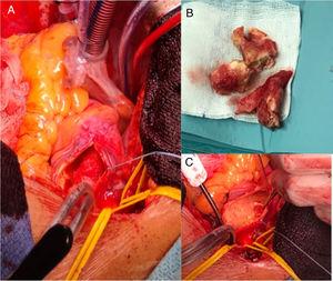 Aortotomía con trombo en cayado aórtico. Pieza quirúrgica. Trombo. Aorta ascendente tras extracción completa del trombo y de la membrana en la base de implantación, en la que se objetiva la integridad total de la capa media y de la íntima.