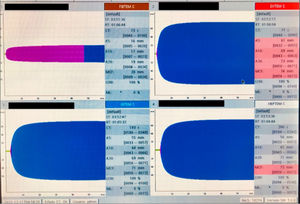 ROTEM®. Perfil de hipercoagulabilidad con valores significativamente más altos en la dureza del coágulo y MCF por encima del límite en EXTEM.