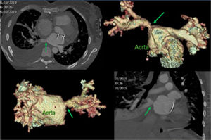 Imágenes tomográficas con reconstrucción tridimensional donde se observa estenosis de venas pulmonares derechas (flecha verde).