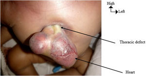 Image showing the defect, the macroscopic appearance of the heart with the absence of any coating.