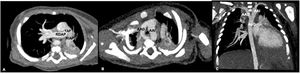 Tomografía, corte axial que muestra: A) arteria pulmonar principal y sus 2 ramas: arteria pulmonar derecha y arteria pulmonar izquierda; B) arcos aórticos que rodean la tráquea de forma circular; C) vista coronal que muestra un doble arco aórtico con la aorta descendente. AAD: arco aórtico derecho; AAI: arco aórtico izquierdo; AoD: aorta descendente; TAP: tronco de la arteria pulmonar; RDAP: rama derecha de la arteria pulmonar; RIAP: rama izquierda de la arteria pulmonar.