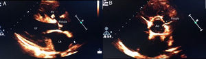 Echocardiography images showing communication between the right coronary sinus and the right ventricle. (A) Highlights the fistula from the sinus of valsava to the right ventricle by a longitudinal paraesternal axis. (B) Shows the communication by a transverse paraesternal axis. RV, right ventricle; LV, left ventricle; LA, left atrium; Ao, aorta.