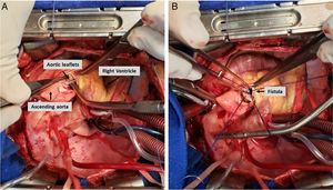 Intraoperative images showing communication between the right coronary sinus and the right ventricle. (A) Vent inserted inside the fistula. (B) Fistula repair with sutures.