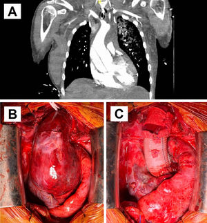 A) Corte coronal de la TC de aorta que confirmó el hallazgo de disección aguda de aorta tipo II de Bakey limitada a la raíz aórtica y aorta ascendente proximal, dilatada con un diámetro máximo de 65mm. B) Fotografía del campo quirúrgico objetivándose dilatación aislada de la raíz aórtica y aorta ascendente proximal. C) Fotografía del campo quirúrgico con sustitución de la raíz aórtica y aorta ascendente por un conducto aortovalvulado con prótesis mecánica y reimplante de ambos ostia coronarios sobre el conducto.