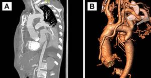 A yB) Reconstrucción de la TC de aorta postoperatoria apreciándose el conducto aortovalvulado con reimplante de coronarias y la coartación de aorta posductal severa de 5x3mm.