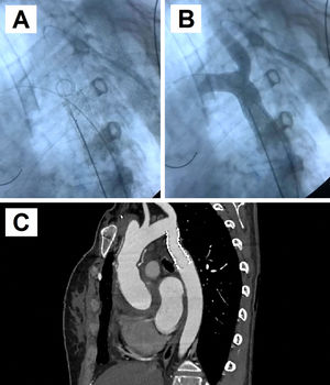 A) Imagen radioscópica en la que se observa el stent cubierto aórtico de 16x58cm implantado en zona 3-4 aórtica, que se ha insertado por vía femoral, con objetivo de expansión a 17mm, con apertura o «flaring» de 20mm de longitud de extremo distal a 22mm de diámetro. También, se observa el catéter pigtail para inyección de contraste a través de la subclavia izquierda, que se ha insertado por vía humeral izquierda. B) Imagen radioscópica de resultado final con inyección de contraste a través del catéter pigtail, confirmando la correcta expansión de la zona coartada. C) Reconstrucción de la TC de aorta postimplante de stent aórtico. Se aprecia el stent implantado en la zona de coartación sin complicaciones.