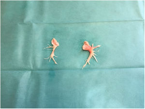 Muestra de material extraído durante una de las intervenciones quirúrgicas.