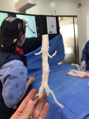 3D modeling printing of abdominal aorta and branches.