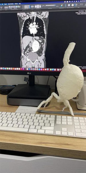 Example of 3D printing of giant abdominal aorta model.