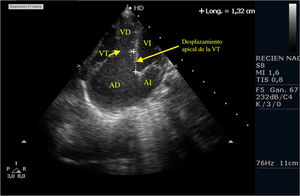 Plano apical de la anomalía de Ebstein. Se muestra la dilatación de la AD y la inserción apical de la VT. AD: aurícula derecha; AI: aurícula izquierda; IT: insuficiencia tricuspídea; VD: ventrículo derecho; VI: ventrículo izquierdo; VT: válvula tricuspídea.