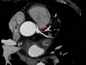 Coronary computed tomography angiography patient 2. Coronary computed tomography angiography showing an anomalous right coronary artery following an inter-arterial course between the pulmonary artery and aorta (red arrow).