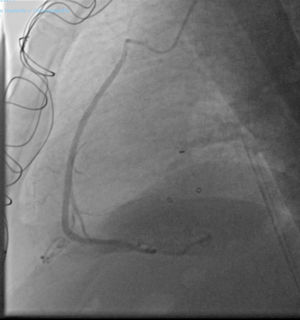 Coronary angiography image patient 2. Coronary angiography image showing the saphenous vein graft with distal anastomosis to the distal right coronary artery before the crux cordis. The patency of the graft can be appreciated.