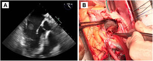 A: Ecocardiografía transesofágica preoperatoria. Se aprecia la masa de gran tamaño anclada al dispositivo de cierre de FOP, en la vertiente auricular izquierda, que protruye hacia la válvula mitral. B: Fotografía del campo quirúrgico. Atriotomía derecha para acceso al septo interauricular donde se encuentra anclado el dispositivo de cierre de FOP, con endotelización incompleta. Resección del dispositivo objetivándose en la vertiente auricular izquierda un absceso adherido.