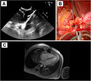 A: Ecocardiografía transesofágica preoperatoria. Se evidencia una masa filamentosa móvil adherida al disco de aurícula derecha del dispositivo de cierre de FOP, próxima a la desembocadura de la vena cava superior, compatible con vegetación sobre el dispositivo. B: Fotografía del campo quirúrgico. Atriotomía derecha para acceso al septo interauricular donde se encuentra anclado el dispositivo de cierre de FOP, con endotelización completa. Resección del dispositivo objetivándose en la vertiente auricular derecha la vegetación filamentosa. C: Resonancia magnética cardiaca postoperatoria. Se aprecia el engrosamiento pericárdico sobre pared ventricular con captación de contraste sugestivo de inflamación.