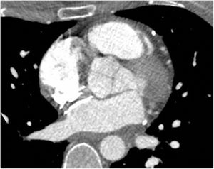 Tomografía computarizada preoperatoria tras drenaje del derrame pericárdico. El dispositivo de cierre de FOP contacta íntimamente, a 1-2 mm, con la pared aórtica, con el techo de la aurícula izquierda y la entrada de la vena cava superior a la aurícula derecha, pero sin identificar claramente punto de solución de continuidad de la pared cardiaca.