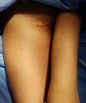 Clinical photograph of the patient showing visible swelling in the anterior and medial aspect of her right thigh up to the groin.