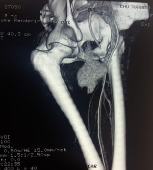 CT scan with tridimensional reconstruction showing an aneurysmatic saccular formation in the dependence of the right common femoral artery.