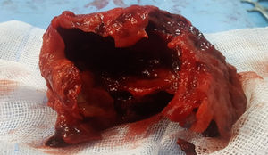 Perioperative view of a large thrombus removed at surgery.
