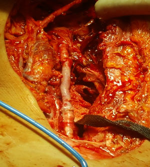 Perioperative view showing the reversed saphenous vein bypass graft of the femoral artery.