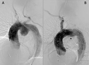 Angiografía preimplante (A) y postimplante (B). Exclusión de aneurisma (*).