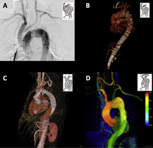 Ejemplos de diferentes tipos de reparación híbrida de arco aórtico (RHA) realizadas en el Complejo Hospitalario Universitario de A Coruña. A.RHA tipo 1. Traslocación de tronco braquiocefálico (TBC) y arteria carótida común izquierda (ACCI) a aorta ascendente y bypass carótido-subclavio izquierdo con sellado endovascular de aneurisma fusiforme de arco aórtico mediante abordaje retrógrado sincrónico. B.RHA tipo 2. Sustitución de hemiarco y traslocación de TBC, ACCI y arteria subclavia izquierda a aorta ascendente y posterior tratamiento endovascular con endoprótesis fenestradas de aneurisma de arco aórtico y toraco-abdominal en un paciente con disección crónica tipo B. C.RHA tipo A. Reparación de aneurisma de arco y aorta torácica descendente en disección crónica tipo A en paciente con síndrome de Marfan mediante tubo valvulado mecánico y trompa de elefante congelada con Thoraflex™ Hybrid Ante-Flo™ (Vascutek-Terumo). D.RHA en zona 1. Paciente con aneurisma sacular de arco aórtico operada mediante bypass carótido-carótido retrofaríngeo y bypass carótido-subclavio izquierdo seguido de implante de endoprótesis NEXUS™ (Endospan Ltd/Jotec GmbH) con rama a TBC.