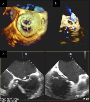 Ecocardiograma de dehiscencia del anillo mitral. a) Ecocardiograma 3D: se visualiza la válvula mitral desde la aurícula con la aorta a las 11 (visión del cirujano). b) Plano de 2 cámaras con Doppler. c) Ecocardiograma 2D plano de 5 y 2 cámaras.