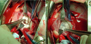 Antes y después de una reparación mitral. Niño de 9 años con valvulopatía mitral primaria con insuficiencia grado iv, en que se realiza cierre de varios clefts y un Alfieri asimétrico. El resultado ecocardiográfico a la salida de quirófano es una insuficiencia mitral grado ii.