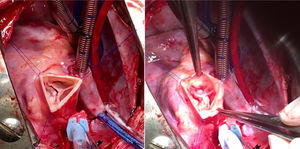 Antes y después de una reparación aórtica. Afeitado del velo coronariano derecho de un adolescente con insuficiencia aórtica severa grado iv por restricción de un velo. El resultado ecocardiográfico a la salida de quirófano es una insuficiencia aórtica trivial.