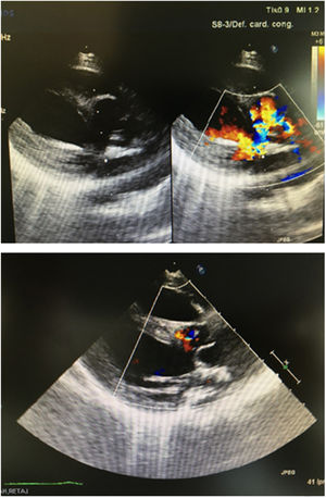 Ecografía del eje largo pre y postoperatorio del paciente 1 (truncus).