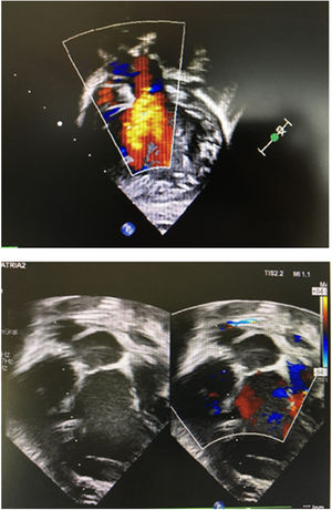 Ecografía del eje largo (preoperatorio) y 4 cámaras (postoperatorio) del paciente 2 (switch arterial).