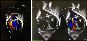Ecografía 4 cámaras pre y postoperatorio de paciente 3 (atresia aórtica).