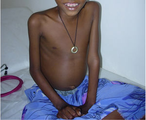 Caso clínico 1. Extrema caquexia en una niña de 8 años. Abdomen globuloso con hepatomegalia y ascitis.