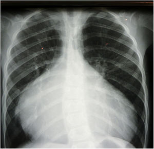 Caso clínico 1. Radiografía de tórax prequirúrgica. Cardiomegalia severa a expensas fundamentalmente de cavidades izquierdas. Datos de redistribución pulmonar.