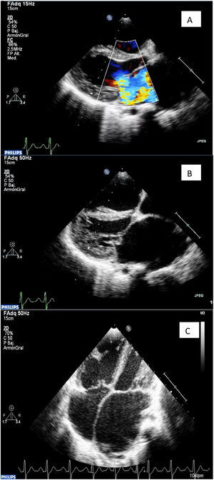 Caso clínico 1. A: Regurgitación mitral severa. B: Imagen de pseudoprolapso de velo anterior mitral. C: Dilatación severa de cavidades.