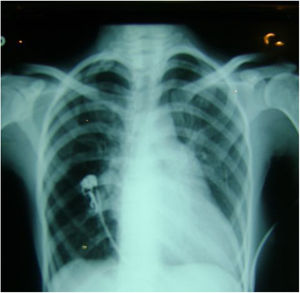 Caso clínico 2. RX de tórax. Cardiomegalia, prominencia de la arteria pulmonar. Datos de redistribución que indican hipertensión pulmonar severa.