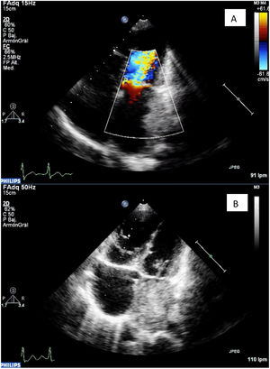 Caso clínico 2. Ecocardiografía prequirúrgica. A: Flujo acelerado a través de la válvula mitral. B: Gran trombo en la aurícula izquierda.