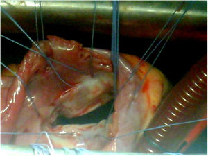 Imagen de la colocación del anillo mitral tras la limpieza, comisurotomía y afeitado de los velos mitrales.
