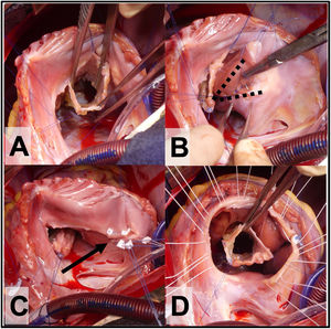 A. Vista del cono con 360° de tejido valvular. B. Plicatura de Carpentier, las líneas punteadas marcan el triángulo de VD no funcional que se excluye con la plicatura. C. Anuloplastia reductora con puntos sueltos (flecha) sobre la línea de la plicatura de la porción auricularizada del VD. D. Se observan los puntos sueltos de sutura a nivel del anillo verdadero que servirán para posicionar el anillo de anuloplastia reductora.