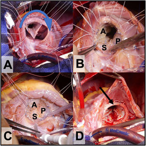 A. Reimplante del cono al anillo verdadero con rotación valvular en sentido horario (sentido de la flecha). B. A: velo anterior, P: velo posterior y S velo septal. C. Prueba de competencia valvular con suero salino antes de implantar el anillo protésico tricuspídeo. D. Anillo tricuspídeo parcial semirrígido in situ (flecha).